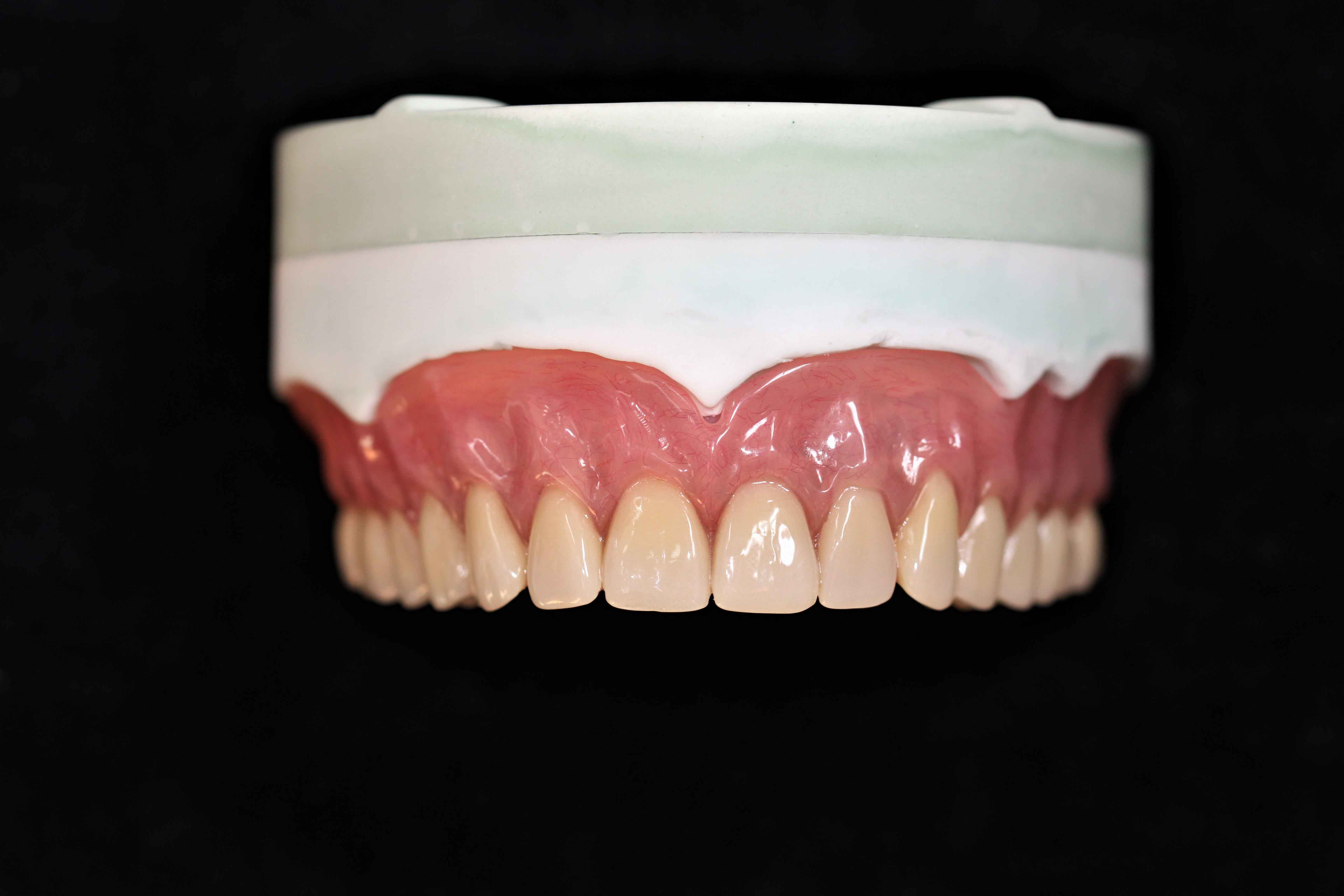 Kina dental lab bestemmelse af lodret afstand af fuld protese