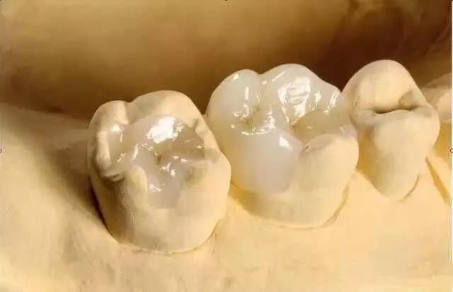 Zirconia tandindlæg til redning af små overfladedefekter af naturtand
