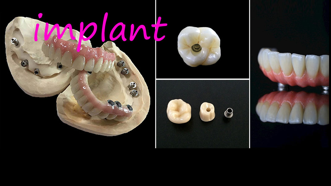 Tandimplantater