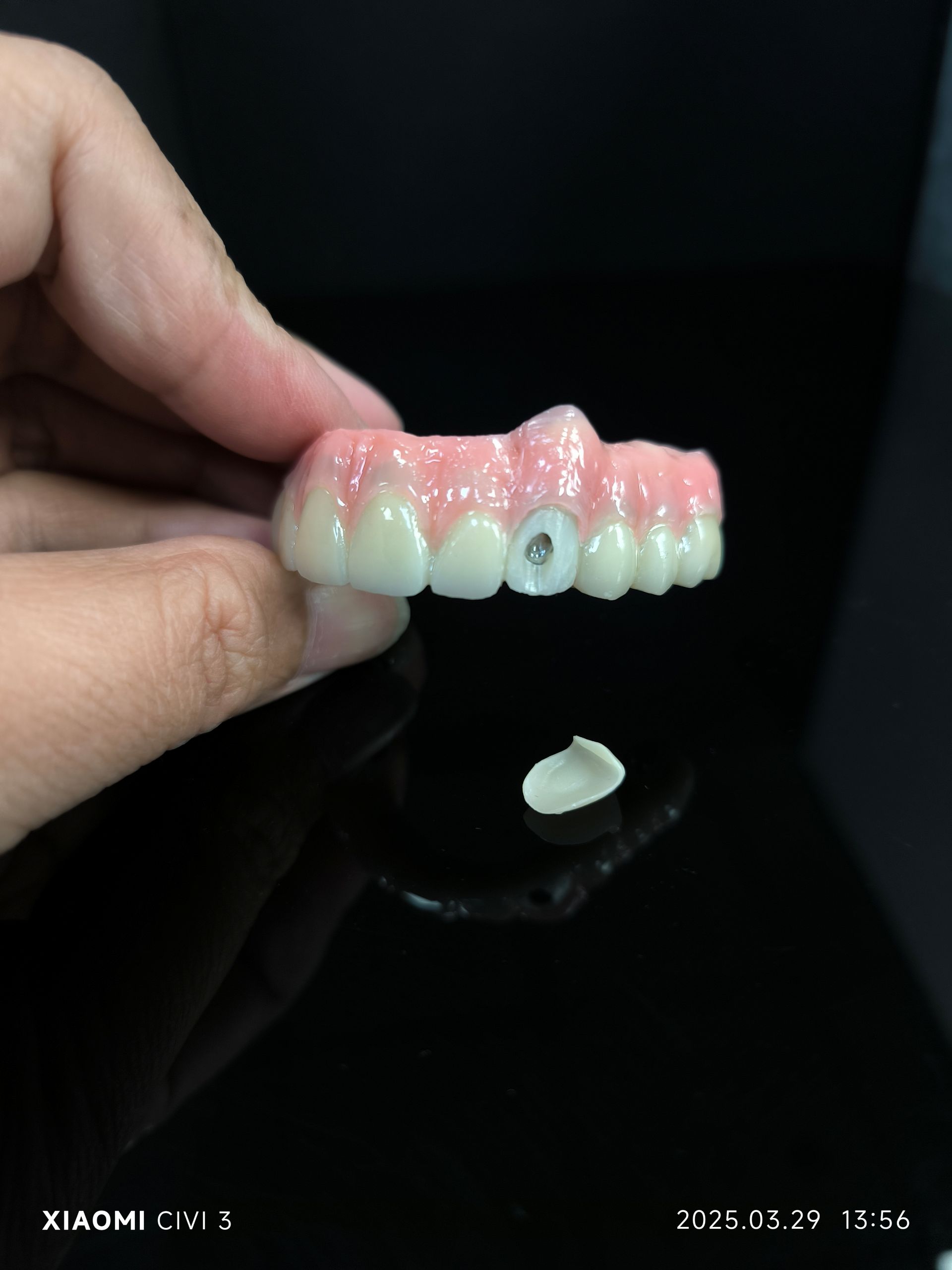 Alt på 4 hybrid - Hybrid Zirconia Bridge -opløsning til vestibulær skruehul