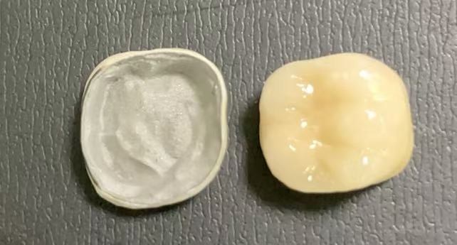 Hvilke betingelser kræves for at få porcelænsfonteret-til-metalkroner?