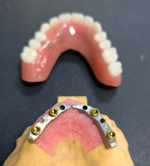 Locator og Titanium Dental Bar