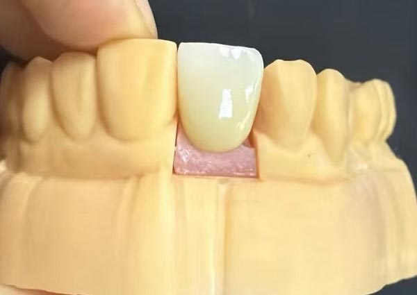 Huller mellem tænderne kan rettes – lige tænder er de mest attraktive!