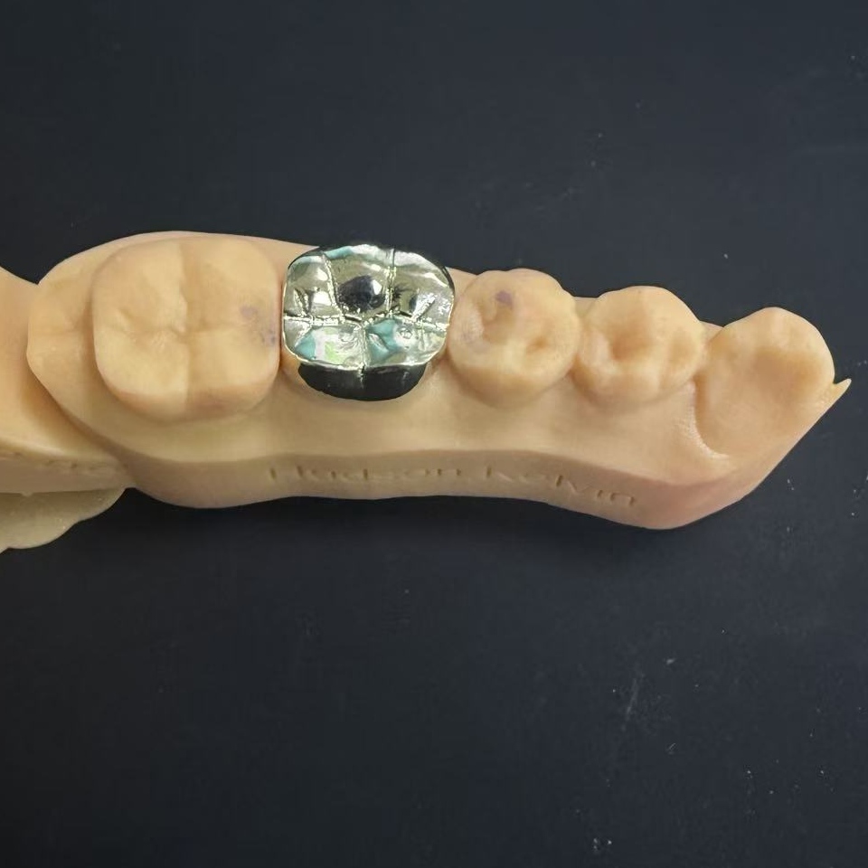 Guldkroner: Ædelmetalvalget til livslang tandrestaurering