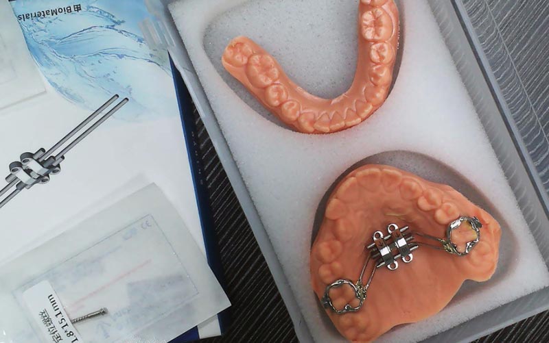 Forstå MSE skeletudvidelse med WM Dental Lab