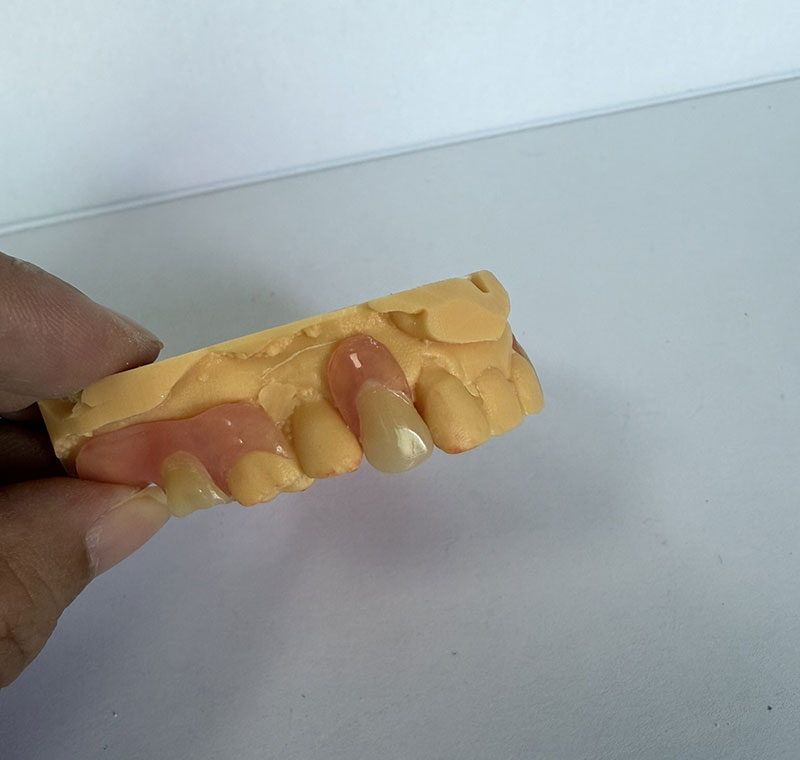Valplast Partials hos WM Dental Lab