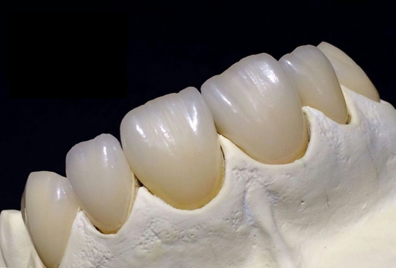 Fuld Zirconia Crown Kina dental laboratorium