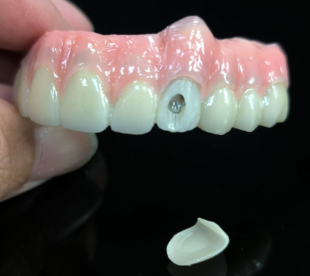 Alt på 4 hybrid - Hybrid Zirconia Bridge -opløsning til vestibulær skruehul