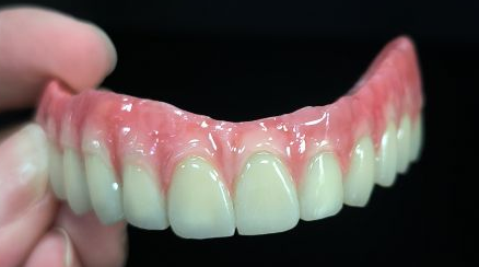 Alt på 4 hybrid - Malo Bridge Full Zirconia Crowns over titaniumstruktur