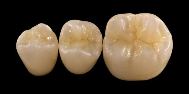 <h2>Zirconia i tandpleje: indikationer, fordele og kliniske overvejelser</h2>
<p>Zirconia er bredt anerkendt for sin styrke og holdbarhed. De seneste generationer af zirconia materialer tilbyder også væsentligt forbedrede æstetiske egenskaber. For patienter, der overvejer helkeramiske restaureringer, er det vigtigt omhyggeligt at evaluere både indikationerne og begrænsningerne for zirconia-baserede systemer.</p>
<p>Nutidens patienter forventer i stigende grad restaureringer, der kombinerer fremragende æstetik med fuld funktionel ydeevne. De fleste moderne keramiske systemer kan opfylde disse forventninger, men klinisk succes afhænger i høj grad af korrekt materialevalg, tandforberedelse og cementeringsprotokoller. Valget bør være styret af nøglematerialeegenskaber såsom brudmodstand, bøjningsstyrke, slidstyrke og langtidsstabilitet. Blandt disse materialer er zirconia blevet en af ​​de mest udbredte muligheder i moderne genoprettende tandpleje.</p>
<h3>Hvorfor vælge zirconia?</h3>
<p>Zirconia er værdsat for sin exceptionelle styrke og langsigtede holdbarhed. Moderne zirconia er væsentligt anderledes end tidligere generationer, som var mere uigennemsigtige og mindre æstetiske. I dag muliggør CAD/CAM-teknologi præcis fremstilling af zirconia-restaureringer med forbedrede optiske egenskaber.</p>
<p>Restaureringer kan designes som:</p>
<ul>
<li><strong>Monolitisk zirconia:</strong>Ideel til posteriore kroner og broer, der tilbyder høj styrke og holdbarhed.</li>
<li><strong>Lagdelt zirconia:</strong>Velegnet til sager, der kræver forbedret æstetik, herunder langvarige restaureringer på tværs af forskellige områder af munden.</li>
</ul>
<p>Bøjningsstyrken varierer afhængigt af typen, der spænder fra ca. 590 MPa i højtranslucens zirconia til op til 1400 MPa i monolitiske former. Zirconia restaureringer kan cementeres ved hjælp af selvklæbende harpikscementer eller harpiksmodificerede glasionomercementer.</p>
<h3>Nøglefaktorer i zirconia materialevalg</h3>
<p>Når man overvejer zirconia til en helkeramisk restaurering, bør klinikere vurdere flere kritiske faktorer:</p>
<ul>
<li>Resterende tandstruktur</li>
<li>Placering i mundhulen (æstetisk zone vs funktionel zone)</li>
<li>Tilstedeværelse af parafunktionelle vaner såsom bruxisme</li>
<li>Gennemskinnelighed af tilstødende naturlige tænder</li>
<li>Farve og tilstand af underliggende tandstruktur</li>
</ul>
<p>Den æstetiske zone omfatter typisk de forreste tænder, selvom den hos nogle patienter kan strække sig til den første kindtand afhængigt af smilelinien og ansigtets dynamik. Den funktionelle zone omfatter generelt præmolarer og kindtænder, hvor okklusale kræfter er væsentligt højere.</p>
<h3>Funktionelle zoneapplikationer</h3>
<p>I posteriore regioner skal okklusale kræfter nøje overvejes. Zirconia er et glimrende alternativ til traditionelle PFM-restaureringer, især i tilfælde med begrænset restaureringsplads. Moderne monolitisk zirconia tillader fuld-kontur design af okklusal anatomi, herunder funktionelle spidser og marginale kamme, samtidig med at høj styrke bevares.</p>
<p>Aktuelle beviser viser, at monolitisk zirconia er velegnet til posteriore kroner og multi-enhedsbroer på grund af dens fremragende modstandsdygtighed over for brud og slid. Fremskridt inden for klæbeteknikker og præparatdesign har også forbedret langsigtede kliniske resultater.</p>
<h3>Æstetiske zoneapplikationer</h3>
<p>I den forreste region skal restaureringer nøje replikere den naturlige tandfarve, translucens og lysadfærd. Mens materialer som lithiumdisilikat tilbyder fremragende æstetik, er de mindre stærke og kræver typisk klæbende limning.</p>
<p>En vigtig fordel ved zirconia er dens evne til at blive konventionelt cementeret, mens den stadig opnår høj æstetisk ydeevne. Med udviklingen af ​​højgennemsigtige og flerlags zirconia-systemer er det nu muligt at producere restaureringer, der tæt efterligner naturlig tandsætning.</p>
<p>Avancerede behandlingsteknikker forbedrer de optiske egenskaber yderligere og reducerer ufuldkommenheder, der kan påvirke lystransmission og udseende.</p>
<h3>Styrke og æstetik kombineret</h3>
<p>Tidlige zirconia-systemer prioriterede styrke, men manglede æstetisk kvalitet. Moderne monolitisk zirconia kombinerer med succes både styrke og forbedret udseende, hvilket gør den velegnet til en bred vifte af kliniske tilfælde.</p>
<p>Det er især gavnligt for patienter med parafunktionelle vaner eller tidligere restaureringsfejl. Kliniske undersøgelser indikerer høj patientaccept og lave komplikationsrater.</p>
<p>Bekymringer vedrørende slid på modsat tandsæt er blevet reduceret med nyere formuleringer. Højpolerede zirconia-overflader udviser lavt slibende potentiale og kan i nogle tilfælde være skånsommere end traditionelle porcelænssmeltet-til-metal-restaureringer.</p>
<h3>Zirconia-implantater: fremvoksende alternativ</h3>
<p>Mens titaniumimplantater forbliver den kliniske standard, vinder zirconiumimplantater opmærksomhed som et metalfrit alternativ. Tidlige designs var primært systemer i ét stykke, men todelte zirkoniumimplantater giver nu mulighed for forbedret protesefleksibilitet.</p>
<p>Zirconia-implantater er særligt nyttige i tilfælde, hvor der er æstetiske bekymringer, såsom potentiel grå misfarvning af peri-implantatvæv eller tynd tandkødsbiotype. De kan også overvejes til patienter med sjælden titaniumfølsomhed.</p>
<p>Zirconiumimplantater er dog stadig relativt nye, og langsigtede kliniske data er stadig begrænsede sammenlignet med titaniumsystemer.</p>
<h3>Konklusion</h3>
<p>Zirconia har udviklet sig til et meget alsidigt materiale inden for genoprettende tandpleje, der tilbyder en stærk balance mellem mekanisk ydeevne og æstetik. Korrekt udvælgelse af tilfælde og overholdelse af kliniske protokoller er afgørende for at opnå optimale resultater i både anterior og posterior applikationer.</p>