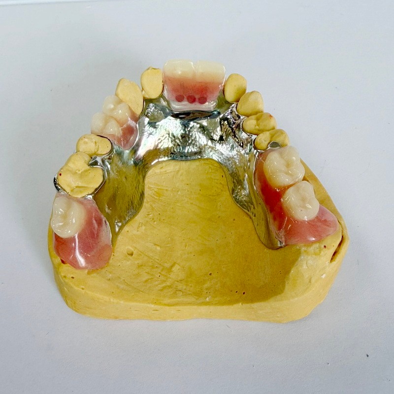 Aftagelig restaurering delvist rammeværk