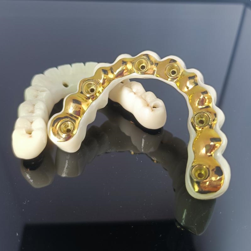 All On X Hybrid Bridge - Fuld Zirconia Bridge over Titanium Bar